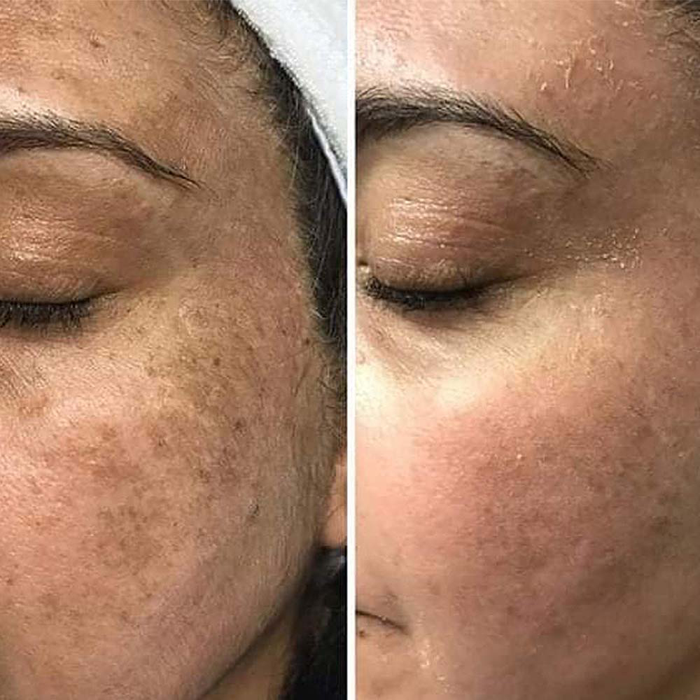 Chemical Peels_beautician_academy