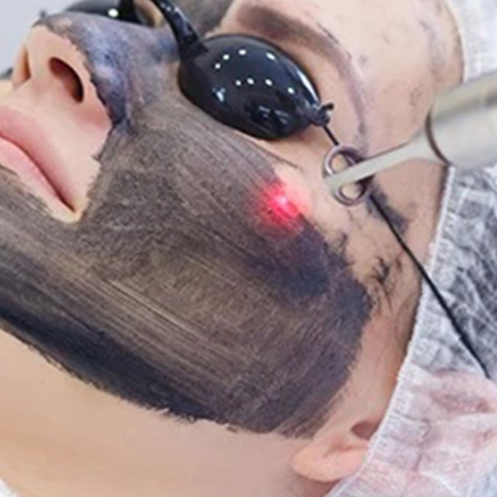 Laser Carbon Facial_beautician_academy