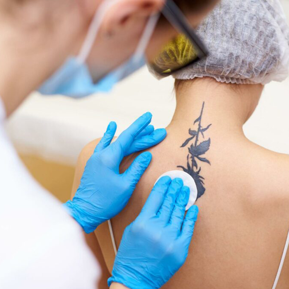 Tattoo Removal_beautician_academy